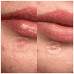 Hero Anti Pimple Patches Original 24gr