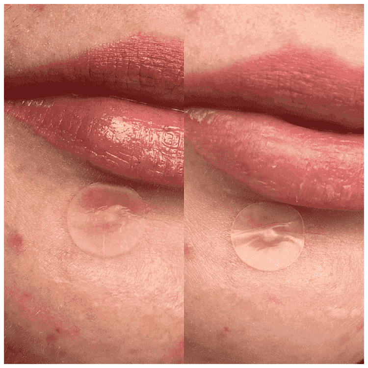 Hero Anti Pimple Patches Original 24gr