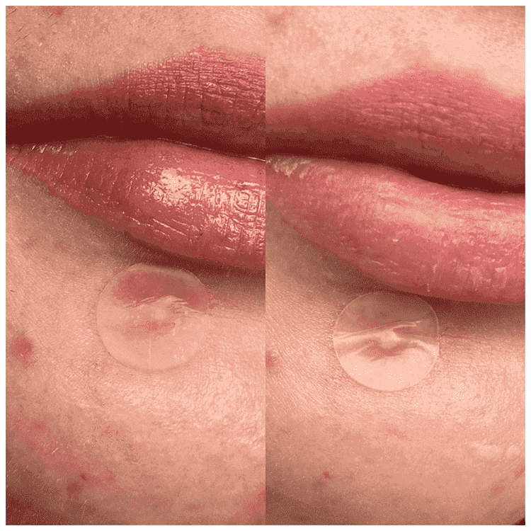 Hero Anti Pimple Patches Invisible 24τεμ